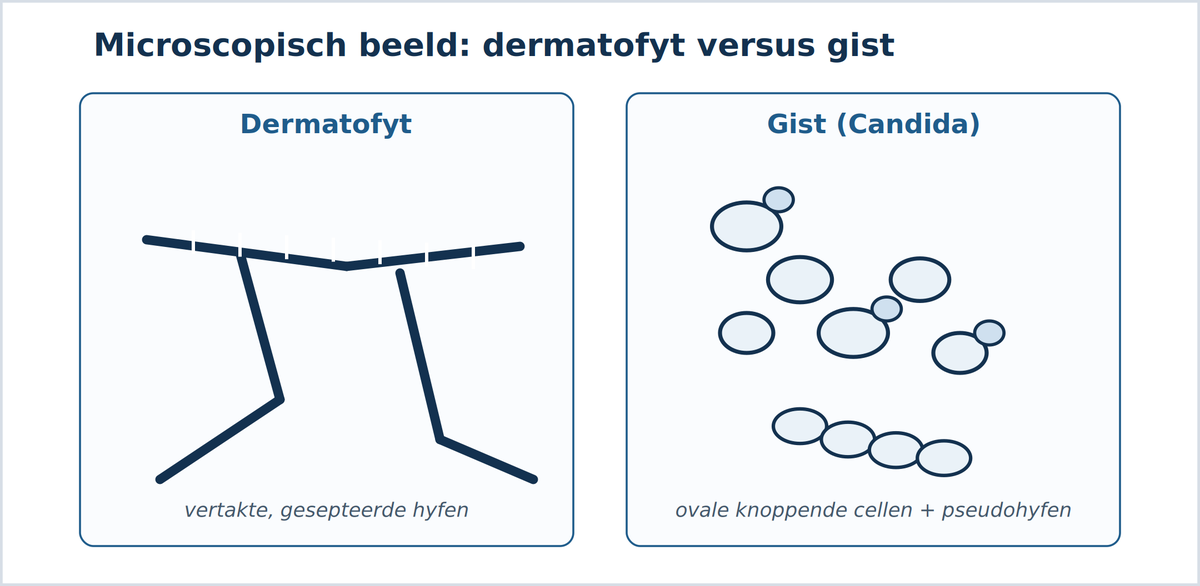 Schimmelinfecties ontcijferd – invasiepatronen onychomycose